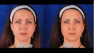 Wrinkle Reduction With NonSurgical Filler Treatments [upl. by Eenhat78]