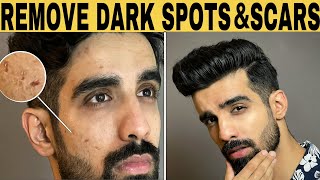 Remove DARK SPOTS amp SCARS NATURALLY  ACNE SCARS HYPERPIGMENTATION BLACK SPOTS ACNE MARKS 2021 [upl. by Nanyt]