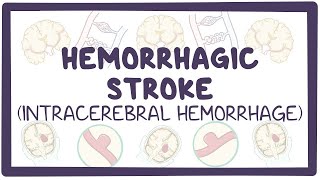 Hemorrhagic stroke intracerebral hemorrhage  causes symptoms diagnosis treatment pathology [upl. by Louis]