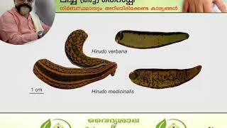 Leech Therapy Malayalam  അട്ട ചികിത്സ  രക്തമോക്ഷം  Blood Letting Malayalam [upl. by Euhc]