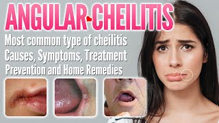 Eczema on lips causes symptoms treatment remedies prevention  Lip dermatitis Lip Cheilitis [upl. by Arratoon]