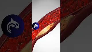 See what a Blood Clot looks like in your arteries  artery bloodclot heart [upl. by Negaem428]