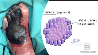 Necrosis and its types coagulative liquefactive caseous fat fibrinoid necrosis fmge neetpg [upl. by Arbma]