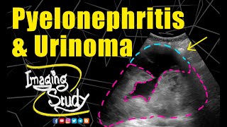 Pyelonephritis with Urinoma  Ultrasound  Case 234 [upl. by Aihsemaj]