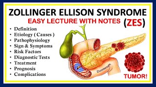 Zollinger Ellison Syndrome ZES Definition Causes Symptom Diagnosis Pathophysiology amp Treatment [upl. by Kirtap]