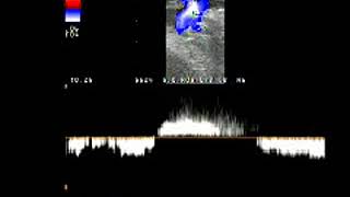 Doppler Venous reflux saphenofemoral junction reflux [upl. by Barcroft]