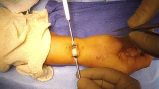 First Extensor Compartment Release for deQuervains Tenosynovitis [upl. by Anaele]