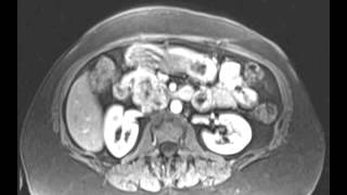 Retroperitoneal Leiomyosarcoma [upl. by Aihsia]