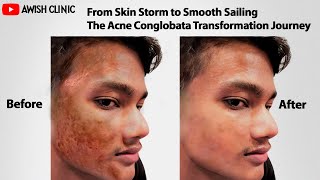 Acne Conglobata Treatment Review by Patient  treated at Awish Clinic in Delhi [upl. by Yetah]