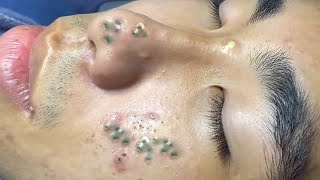 Big Cystic Acne Blackheads Extraction Blackheads amp Milia Whiteheads Removal Pimple Popping  4010 [upl. by Hannover]