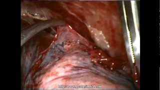 Thoracoscopy VATS Decortication in stage 2 empyema Delhi Noida India [upl. by Niltiac]