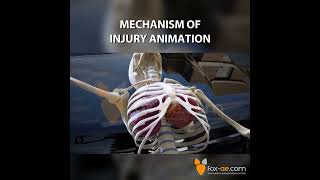 Mechanism of Injury Animation [upl. by Huoh]