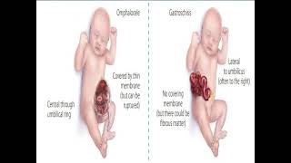 Omphalocele vs Gastroschisis [upl. by Aeirdna887]