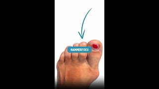 What is a hammertoe hammertoe podiatrist [upl. by Dorice712]