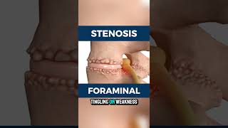 What is foraminal stenosis [upl. by Corinna]