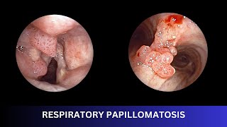 RESPIRATORY PAPILLOMATOSIS  Bronchoscopic Management [upl. by Hazmah]