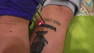 Tattoo Removal 1st Treatment with Cutera Enlighten [upl. by Erskine]