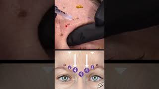 How to treat the Glabella in 30 seconds 💉 [upl. by Kristi888]