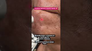 Freckles Treatment Sunspots  Dermatologist in Punjab  Dr Ashima Goelskincare [upl. by Pals]