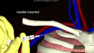 Subclavian Vein Access  Normovolemic Patient Animation by Cal Shipley MD [upl. by Alvinia]