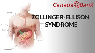 ZollingerEllison syndrome [upl. by Aserat546]