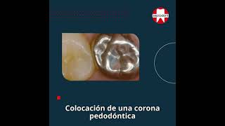 Pulpotomia con Biodentine  Caso clinico de la Lucile Goupy [upl. by Iteerp288]