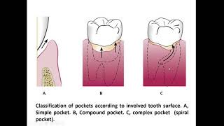 Periodontal Pocket Dr Enas Elgendy [upl. by Iren803]