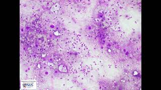 Thyroid cytology  Anaplastic thyroid carcinoma [upl. by Kathie]