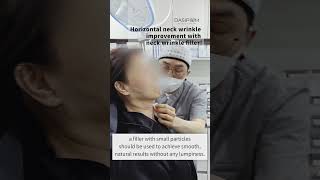 Horizontal neck wrinkle improvement with neck wrinkle filler NeckWrinkleFiller facelift [upl. by Duomham]