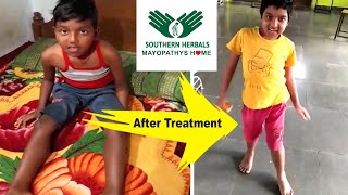 Duchenne muscular dystrophy treatment in india [upl. by Airlia]