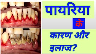 Dental pyorrheapyria kyu hota hai पायरिया के कारण और उपचार [upl. by Norel]