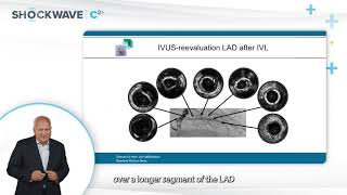 Sneak Peek Shockwave C2 case by Prof Haude amp Dr Golabkesh Heavily Calcified Long LAD Stenosis [upl. by Barrie959]