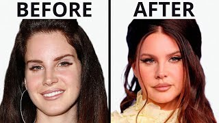 Lana Del Reys SHOCKING Transformation  Plastic Surgery Analysis [upl. by Aikaz382]