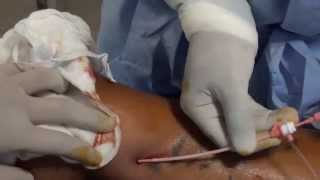 RF Ablation for Varicose Vein Radiofrequency Ablation VaricoseVeins Video [upl. by Lais598]