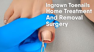 Ingrown toenail Home treatment and removal surgery3d animation [upl. by Eihcra]