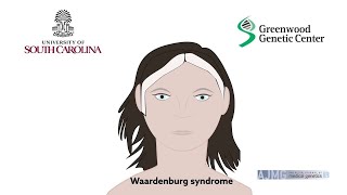 Biallelic deletions of the Waardenburg II syndrome gene SOX10 cause a recognizable arthrogryposis [upl. by Millisent185]