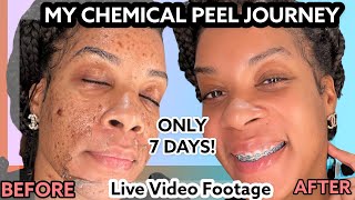 How I Cleared My Acne amp Hyperpigmentation In 7 DAYS Chemical Peel Skin Care Routine [upl. by Linea]