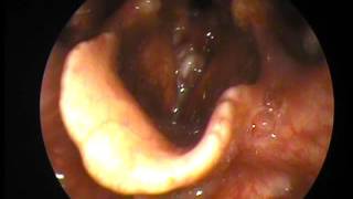 Glottic Carcinoma pre and after Direct Laryngoscopy [upl. by Shafer563]