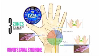 Three zones of ulnar nerve compression in Guyons canal Ulnar nerve entrapment neuropathy anatomy [upl. by Nnylrahc]