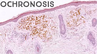 Exogenous Ochronosis possible side effect of hydroquinone skin lightening cream pathology dermpath [upl. by Suivatnod]