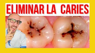 ⚠️Como se hace un EMPASTE DENTAL ✅ Reconstrucción clase I y II [upl. by Adiehsar]