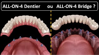 All on 4  Type de prothèse  Dentier ou Bridge [upl. by Bakerman]