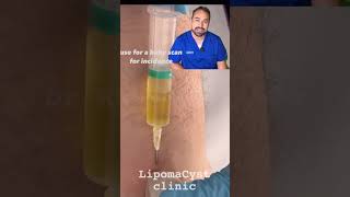 Bakers cyst treatment skincare dr Khaled Sadek explains [upl. by Lorrad]