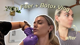 Lip Filler  Botox Vlog  Before amp After [upl. by Airtal436]