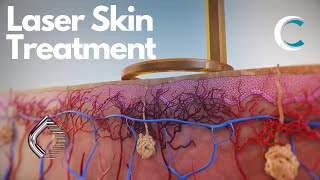 Next Generation Laser Treatment of Skin Lesions and Pigmentation by Candela 3D medical animation [upl. by Asilam608]