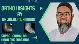 Dr Jalal Orthopedics made easySUPRACONDYLAR HUMERUS FRACTURE [upl. by Hatnamas]