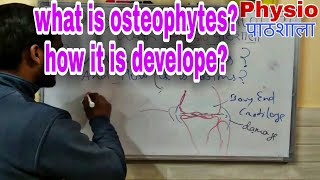 Osteophytes how it is develope [upl. by Philipa]