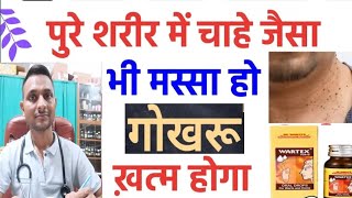 Warts  illa  Corn  Gorkhu gorkhul  Homeopathic medicine for warts corn  गोखरू  तिल और मस्से [upl. by Ambrosius306]