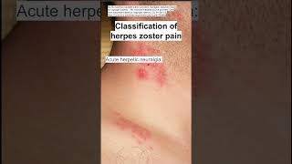 Classification of herpes zoster shingles pain [upl. by Ainnat253]