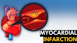 Myocardial Infarction Causes Signs and Symptoms Diagnosis and Treatment [upl. by Atnek]